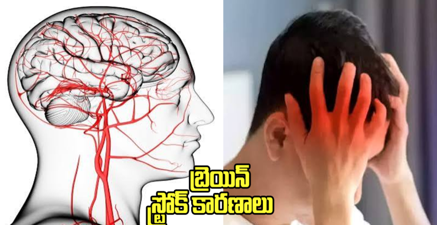 don't do these mistakes for avoiding brain stroke issues